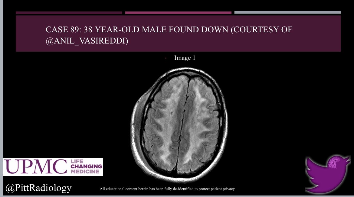 Katie S. Traylor MS, DO, DABR (@katietraylordo) on Twitter photo UPMC Case #89. Thanks @anil_vasireddi for the great case. No spoilers! <a href="/PoojithaRadi/">Poojitha Reddy</a> <a href="/SurajParikhMD/">Suraj Parikh, MD</a> <a href="/madeline_leo/">Madeline Leo</a> <a href="/DrPepperMD6/">Sarah Pepley</a> <a href="/tysontragon/">Tyson Tragon</a> <a href="/VikasAgarwalMD/">Vikas Agarwal</a> <a href="/LaurenGrayDO/">Lauren Gray</a> <a href="/J_McCloskeyMD/">Justin McCloskey, MD</a> <a href="/AngelaUbanwa/">Angela, M.D.</a> <a href="/HarryTsouJrVIR/">Harry Tsou Jr.</a> <a href="/DavidHastie12/">David Hastie</a> <a href="/m_nicoleau/">Marvin Nicoleau, MD</a> <a href="/ChristineDoepk2/">Christine Doepker, MD</a> @EvaChau13 <a href="/JudyGadde/">Judy Gadde, DO, MBA</a> UPMC Case #89. Thanks @anil_vasireddi for the great case. No spoilers! <a href="/PoojithaRadi/">Poojitha Reddy</a> <a href="/SurajParikhMD/">Suraj Parikh, MD</a> <a href="/madeline_leo/">Madeline Leo</a> <a href="/DrPepperMD6/">Sarah Pepley</a> <a href="/tysontragon/">Tyson Tragon</a> <a href="/VikasAgarwalMD/">Vikas Agarwal</a> <a href="/LaurenGrayDO/">Lauren Gray</a> <a href="/J_McCloskeyMD/">Justin McCloskey, MD</a> <a href="/AngelaUbanwa/">Angela, M.D.</a> <a href="/HarryTsouJrVIR/">Harry Tsou Jr.</a> <a href="/DavidHastie12/">David Hastie</a> <a href="/m_nicoleau/">Marvin Nicoleau, MD</a> <a href="/ChristineDoepk2/">Christine Doepker, MD</a> @EvaChau13 <a href="/JudyGadde/">Judy Gadde, DO, MBA</a>