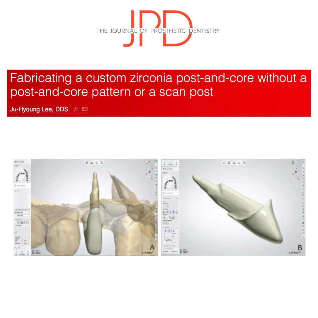 JPDentistry's tweet photo. This #dentaltechnique describes a combined analog #dentalimpression and #CADCAM approach that simplifies the process for a #zirconia #postandcore #dentalrestoration.
Learn more: https://t.co/XRyfiHdIHr https://t.co/XsyU5DdWtR