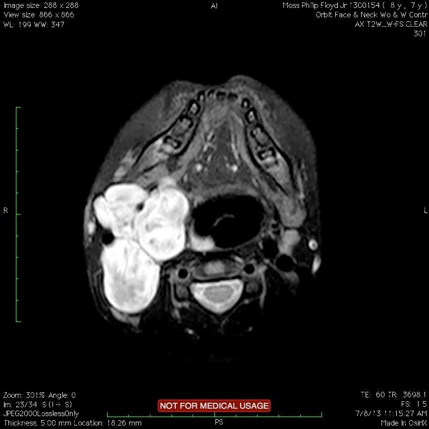 RenieMoss's tweet photo. This is Philip’s tumor in 2012. This image was just taken 18 months after surgery to remove it. It threatened his airway, blood vessels, motor function, and vagus nerve.  This type of tumor has a 10-15% risk of turning malignant.  #benignisnotfine 
#ENDNF https://t.co/ezLKr14oRD