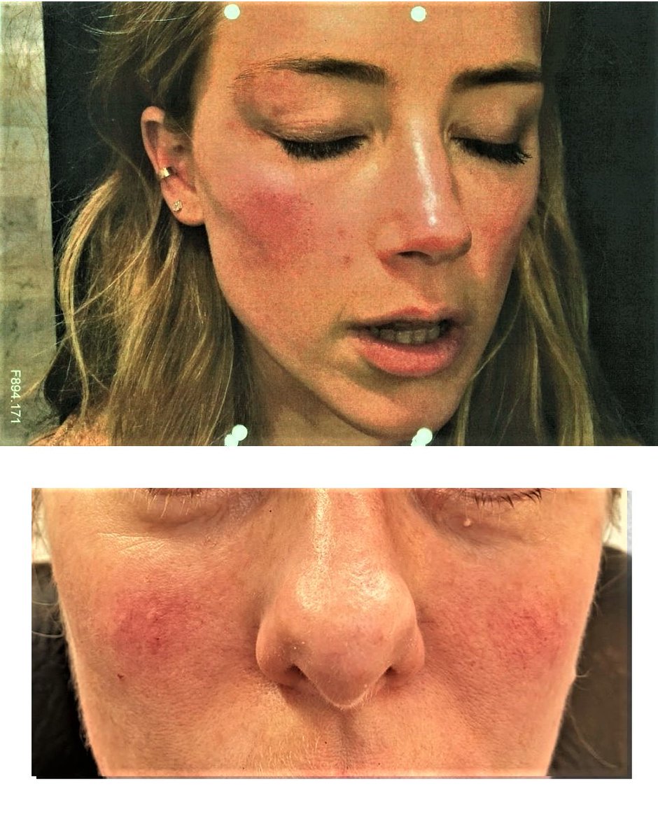 Red blotchy face/pink cheeks- it could be due to many things as simple as anxiety to plausibly vomiting, rosacea, and/or skin care regimes. Chemical peels, dermaroller, facials, fillers, etc... Here are some comparisons.