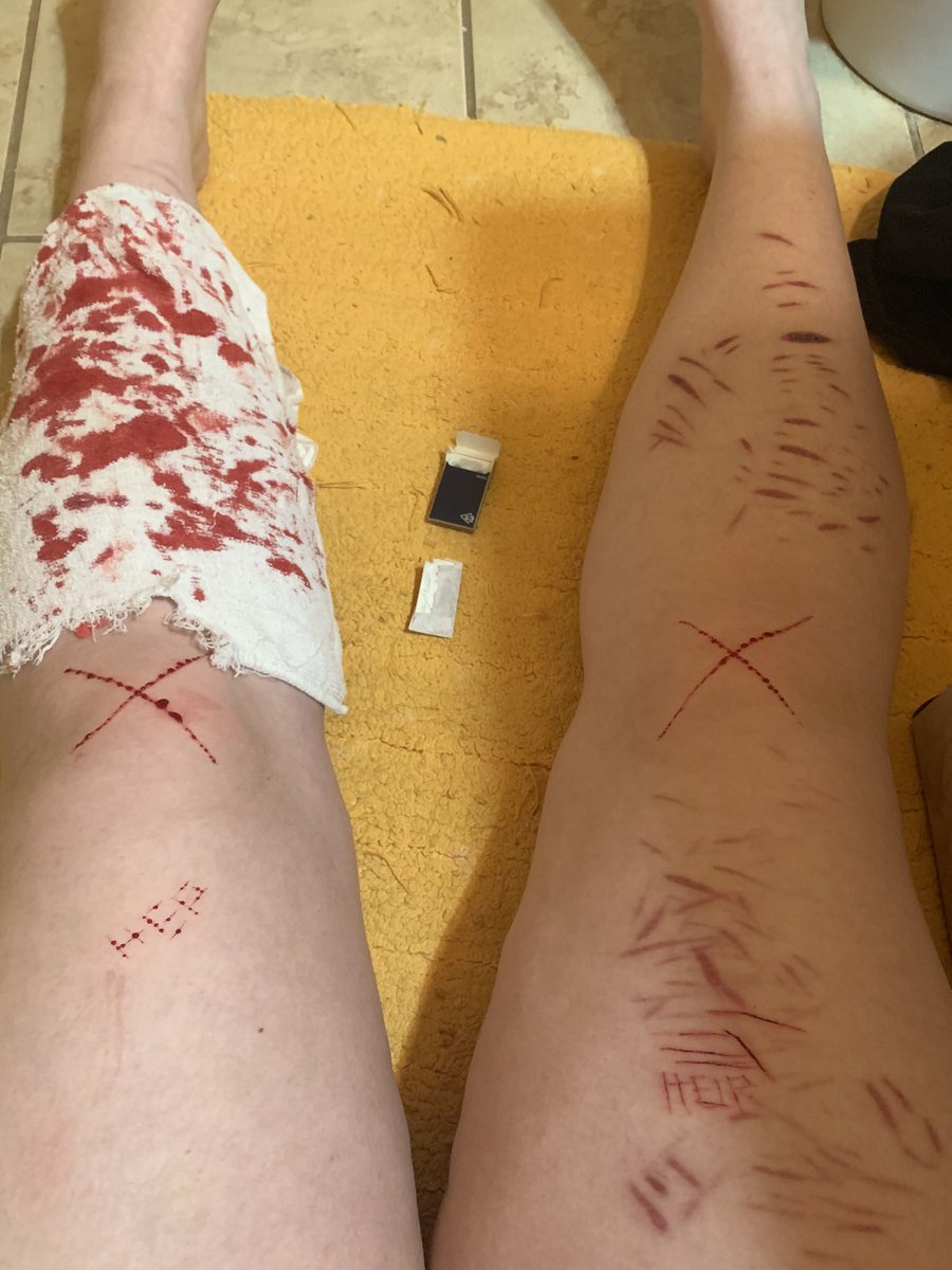 alrighty222's tweet photo. !!TW!!
legs <3
-
-
-
-
-
-
-
-
-
-
-
Shtwt bladetwt cuttwt barcodetwt styrotwt beantwt scartwt b4nd4idtwt catscratchtwt armgilltwt fasciatwt goretwt https://t.co/qUM8bk4bdI