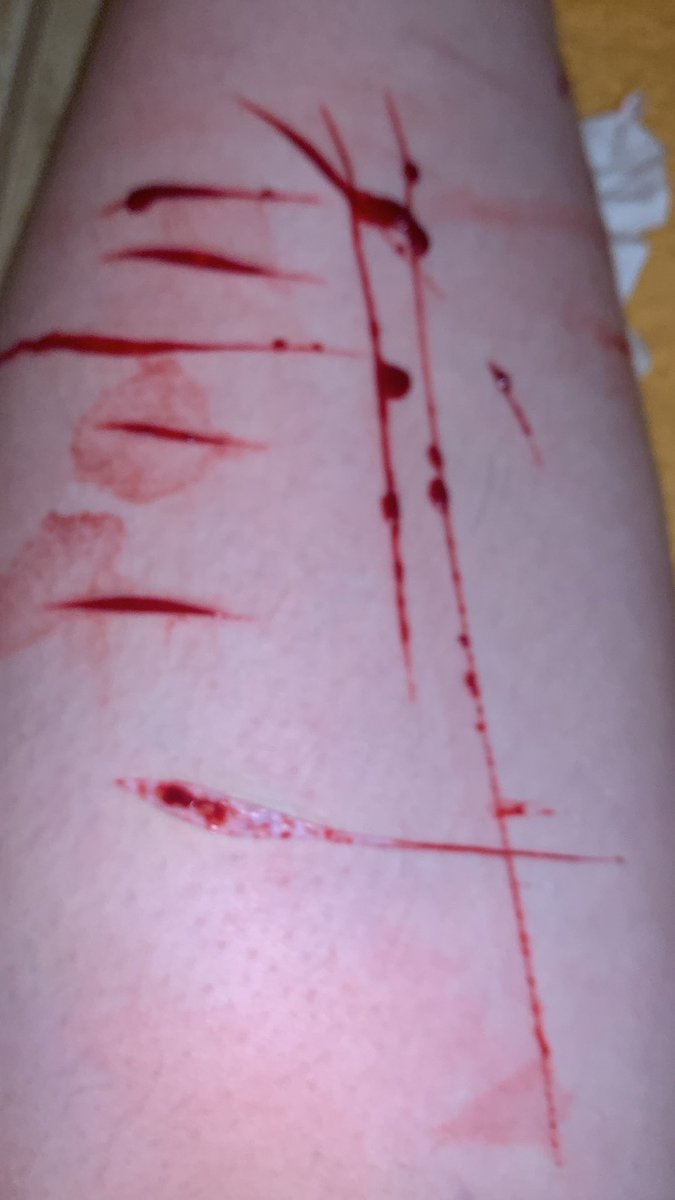alrighty222's tweet photo. !!TW!!
legs <3
-
-
-
-
-
-
-
-
-
-
-
Shtwt bladetwt cuttwt barcodetwt styrotwt beantwt scartwt b4nd4idtwt catscratchtwt armgilltwt fasciatwt goretwt https://t.co/qUM8bk4bdI
