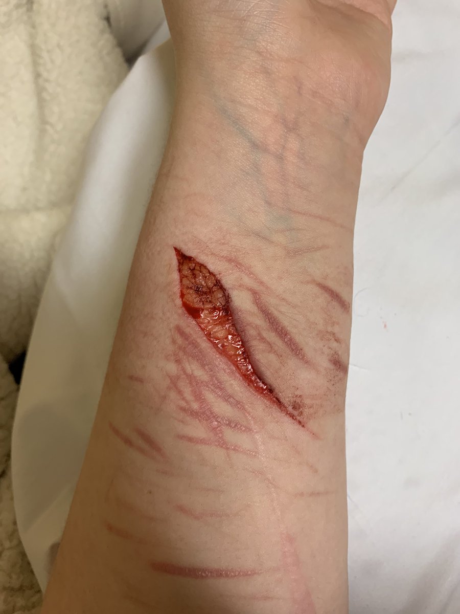 alrighty222's tweet photo. !!TW!!
this is now my fav
-
-
-
-
-
-
-
-
-
-
-
-

Shtwt bladetwt cuttwt barcodetwt styrotwt beantwt scartwt b4nd4idtwt catscratchtwt armgilltwt fasciatwt goretwt https://t.co/rqEj3q8BrW