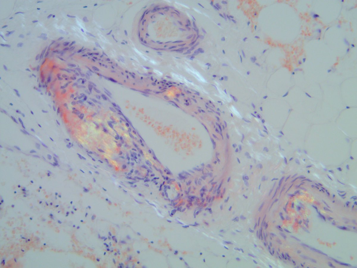Tip for PGY1s. Not everything that is birefringent on a Congo Red stain is amyloid. If the birefringent material is white it is collagen. Amyloid is green.

#pathology #pulmpath