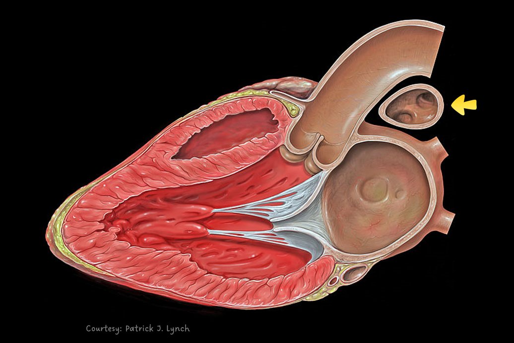 NephroP's tweet photo. As our #POCUS friends seem to like the #echofirst #anatomy quizzes, lets do one more.
What is the structure indicated by arrow in this parasternal long axis view?
#MedEd #Nephrology https://t.co/Y6LRhlAvBR
