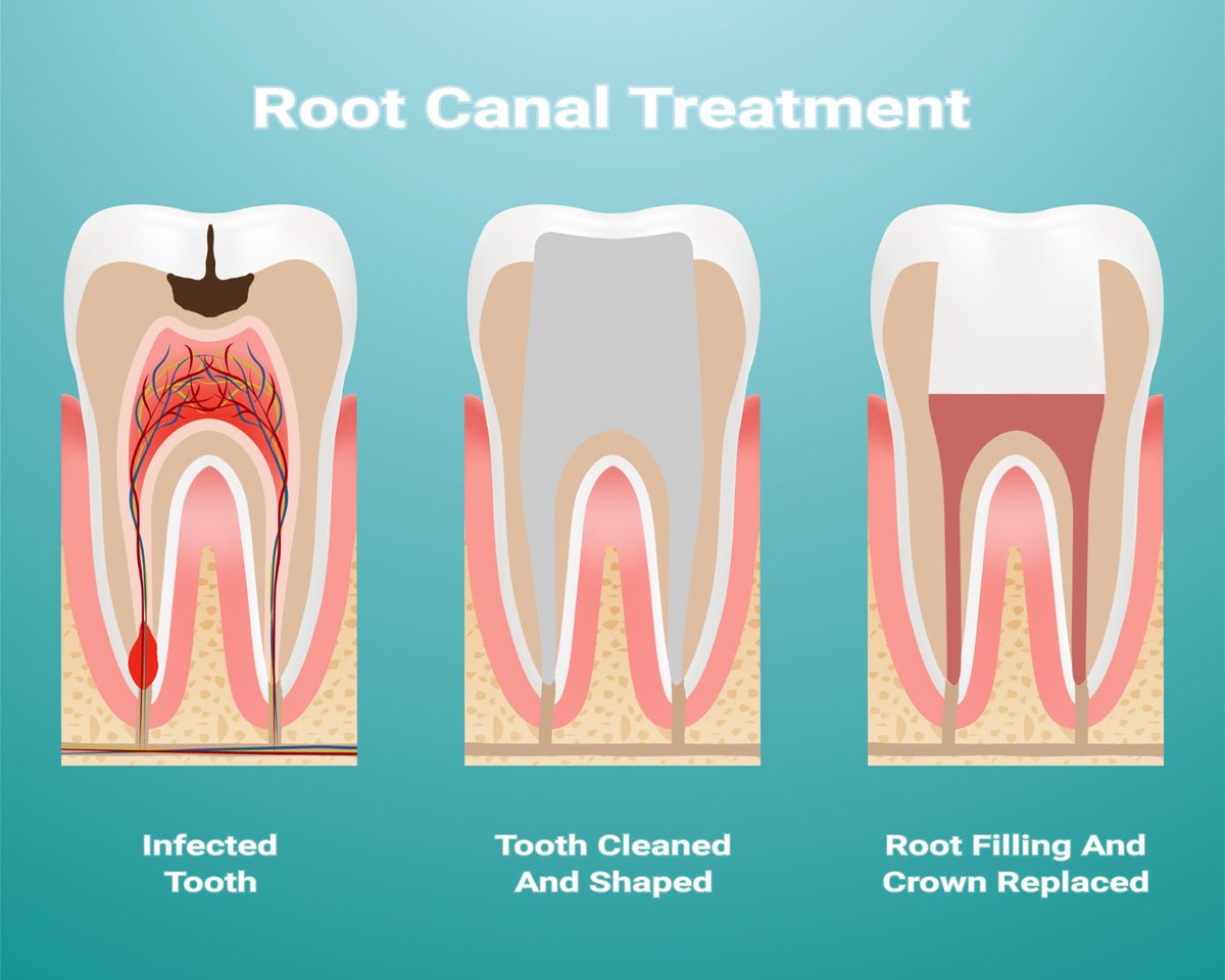 thetooth_dr's tweet photo. Root Canal Treatment!
#flossdental #thetooth_dr #flossboss #dentist #rootcanalawarenessweek #greenhithedental #oralhealth #dentistry #trinidadandtobago https://t.co/PwrPD5NLNh
