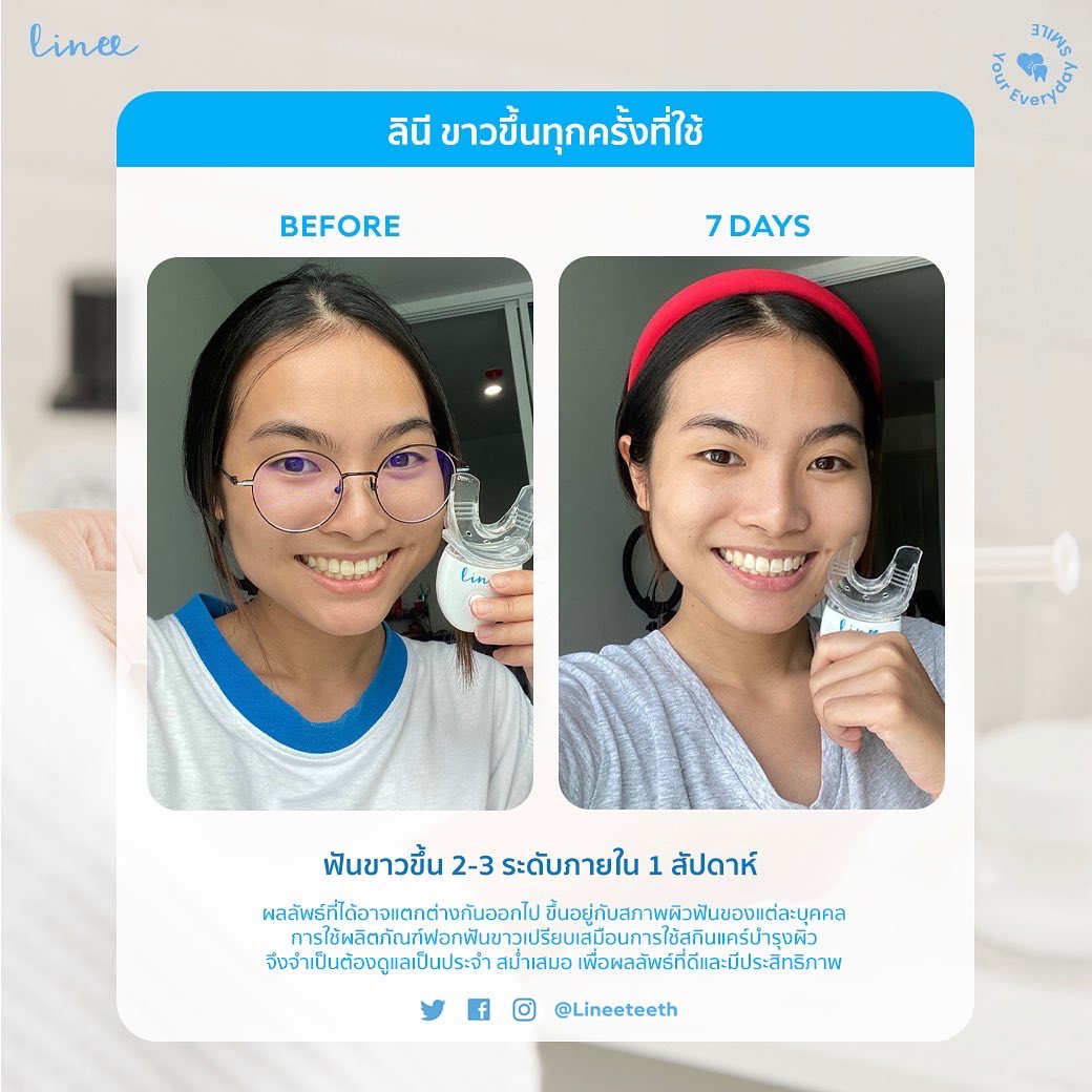 ลินีเก็บรีวิวหลังใช้ต่อเนื่องมาฝากทุกคน ขาวขึ้นจริงแบบปัง✨ *รีวิวจากผู้ใช้จริง 👩🏻

👉🏻 ผลลัพธ์ที่ได้อาจแตกต่างกันออกไปขึ้นอยู่กับสภาพผิวฟันของแต่ละบุคคล

👉🏻 การฟอกฟันเปรียบเสมือนการใช้สกินแคร์บำรุงผิว จึงจำเป็นต้องดูแลเป็นประจำสม่ำเสมอ เพื่อผลลัพธ์ที่มีประสิทธิภาพ #lineeteeth