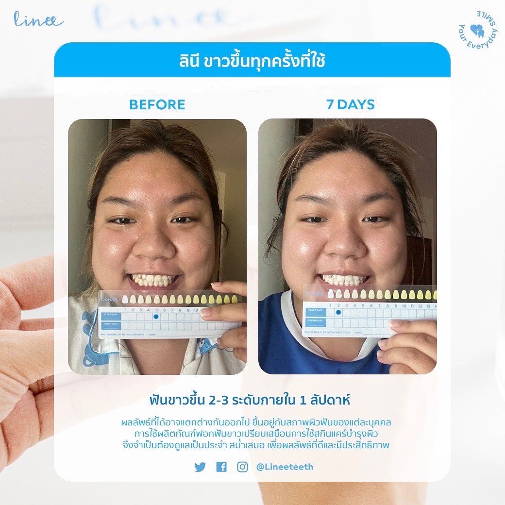 lineeteeth's tweet photo. ลินีเก็บรีวิวหลังใช้ต่อเนื่องมาฝากทุกคน ขาวขึ้นจริงแบบปัง✨ *รีวิวจากผู้ใช้จริง 👩🏻

👉🏻 ผลลัพธ์ที่ได้อาจแตกต่างกันออกไปขึ้นอยู่กับสภาพผิวฟันของแต่ละบุคคล

👉🏻 การฟอกฟันเปรียบเสมือนการใช้สกินแคร์บำรุงผิว จึงจำเป็นต้องดูแลเป็นประจำสม่ำเสมอ เพื่อผลลัพธ์ที่มีประสิทธิภาพ #lineeteeth https://t.co/0tBgF4Xrtg