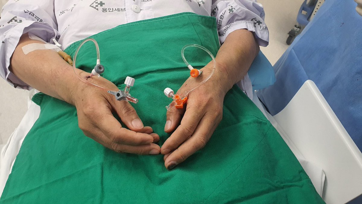 YongcheolKim2's tweet photo. It seems to be femoral approach, but reality is both SNUFFBOX!!!
-7-Fr EBU 3.5 via #ldTRA using 7-Fr Slender sheath for the anterograde approach
-5-Fr JR 3.5 via #RdTRA using 5-Fr Slender sheath for collateral flow from RCA
Let’s beccome #Snuffboxer !! https://t.co/Zr71YkVU4L