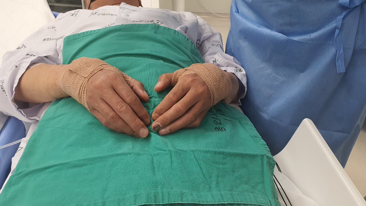 YongcheolKim2's tweet photo. It seems to be femoral approach, but reality is both SNUFFBOX!!!
-7-Fr EBU 3.5 via #ldTRA using 7-Fr Slender sheath for the anterograde approach
-5-Fr JR 3.5 via #RdTRA using 5-Fr Slender sheath for collateral flow from RCA
Let’s beccome #Snuffboxer !! https://t.co/Zr71YkVU4L
