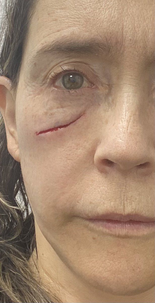 Marce valencia yoya (@marcevalenciar) on Twitter photo Tuve un accidente casero. Tengo EPS SANITAS Y MEDICINA PREPAGADA. Llegué a urgencias de la <a href="/ClinicaColombia/">Clinica Colombia</a> a las 430 am, lavaron la herida, deben coger puntos, después de 3 horas no me ha atendido cirujano plástico, porque no tienen.
Estoy asustada. Es mi cara.
Por fa RT. Tuve un accidente casero. Tengo EPS SANITAS Y MEDICINA PREPAGADA. Llegué a urgencias de la <a href="/ClinicaColombia/">Clinica Colombia</a> a las 430 am, lavaron la herida, deben coger puntos, después de 3 horas no me ha atendido cirujano plástico, porque no tienen.
Estoy asustada. Es mi cara.
Por fa RT.