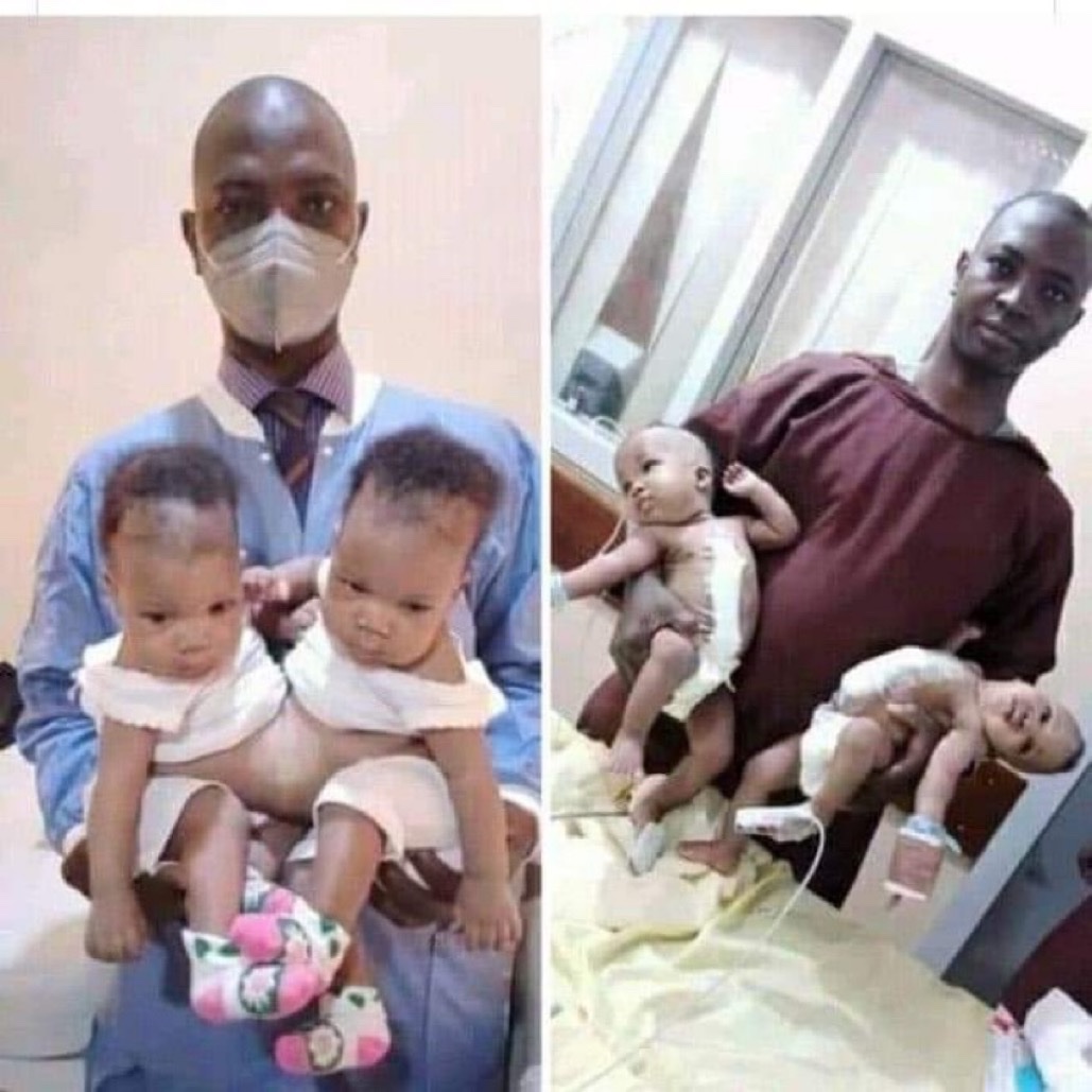 NigeriaStories's tweet photo. Wow 🤩 
A team of Nigerian Based Doctors have Successfully Separated Conjoined Twins at the University Of Ilorin Teaching Hospital Kwara State, Nigeria https://t.co/o34mTLkUcB