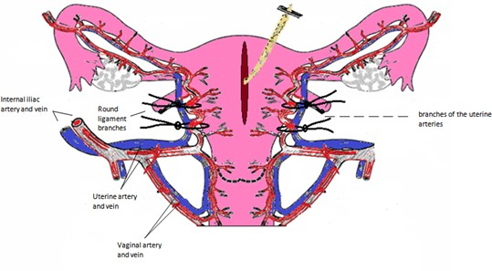 CEOGjournal's tweet photo. Bilateral ascending uterine arteries ligation for conservative management of complete placenta previa: three case reports
🔗https://t.co/vUJGRYNU2E
#Placenta_previa #cesarean #cesarean_section https://t.co/tvE6qs959y