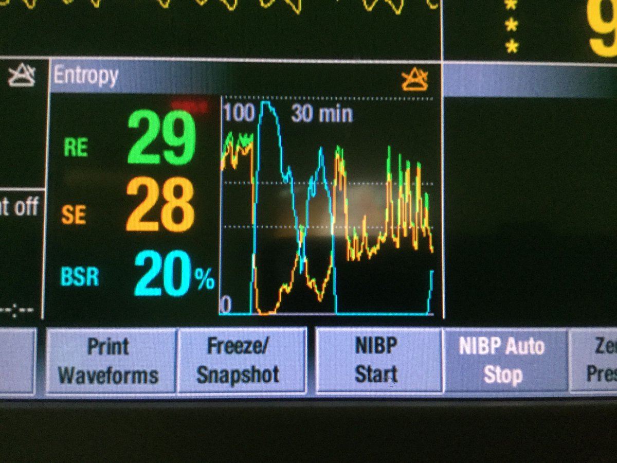 NaveenEipe's tweet image. Thanks!
*Switching between &amp;amp; back during GA, can eliminate monitoring artifacts without inc. the risk #AAGA?

BTW, looking forward to your talk @EAFestival and hoping to chat further about using depth of anesthesia #DOA monitoring in #MObesity

eafest.org/joom2/