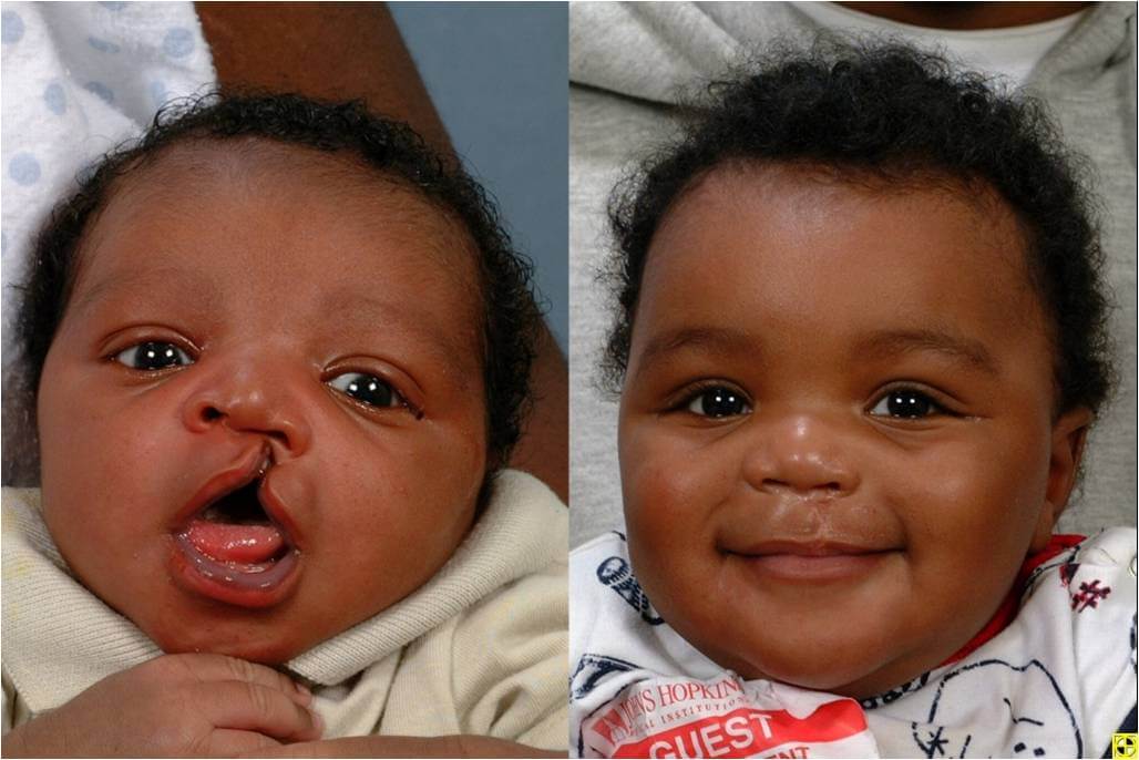 news_ghana's tweet photo. Cleft lips, palates: the birth defect that steals babies’ smiles https://t.co/zmN4CQVcsz #FeaturedArticles #babiessmiles #birthdefect #Cleftlips #palates https://t.co/LH5DgwNlwo