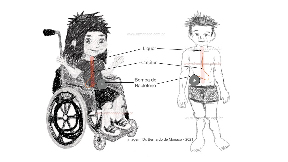 Bomba de baclofeno intratecal como tratamento da espasticidade. #CerebralPalsy #Spasticity #Baclofen 

drmonaco.com.br/website/index.…
