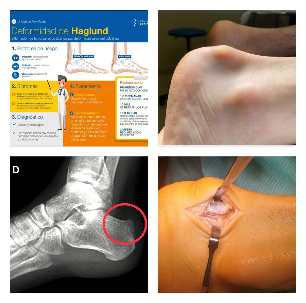 DrSergiohorte's tweet photo. 🔴DEFORMIDAD DE HAGLUND🔴

▪️Aumento de la protuberancia posterior del calcáneo

▪️Dolor insercional posterior sobre Tendón de Aquiles.

🟢La calcaneoplastia abierta aporta buenos resultados y una recuperación precoz con carga inmediata

🔵Unidad Pie y Tobillo @ClinicaCEMTRO 🟡 https://t.co/OR8bUBU1TA