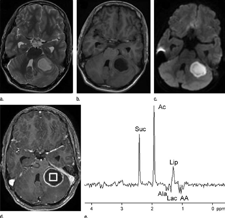 JNeurosurgical's tweet photo. Effect of antibiotic therapy on proton MR spectroscopy findings in human pyogenic brain abscesses
https://t.co/QQw7anXVzQ
#JNSS #neurosurgery #edizioni_minerva_medica #ArticleOfTheDay #surgeon #neurosurgeon #brain #pyogenicabscess https://t.co/CEZBniVrmJ