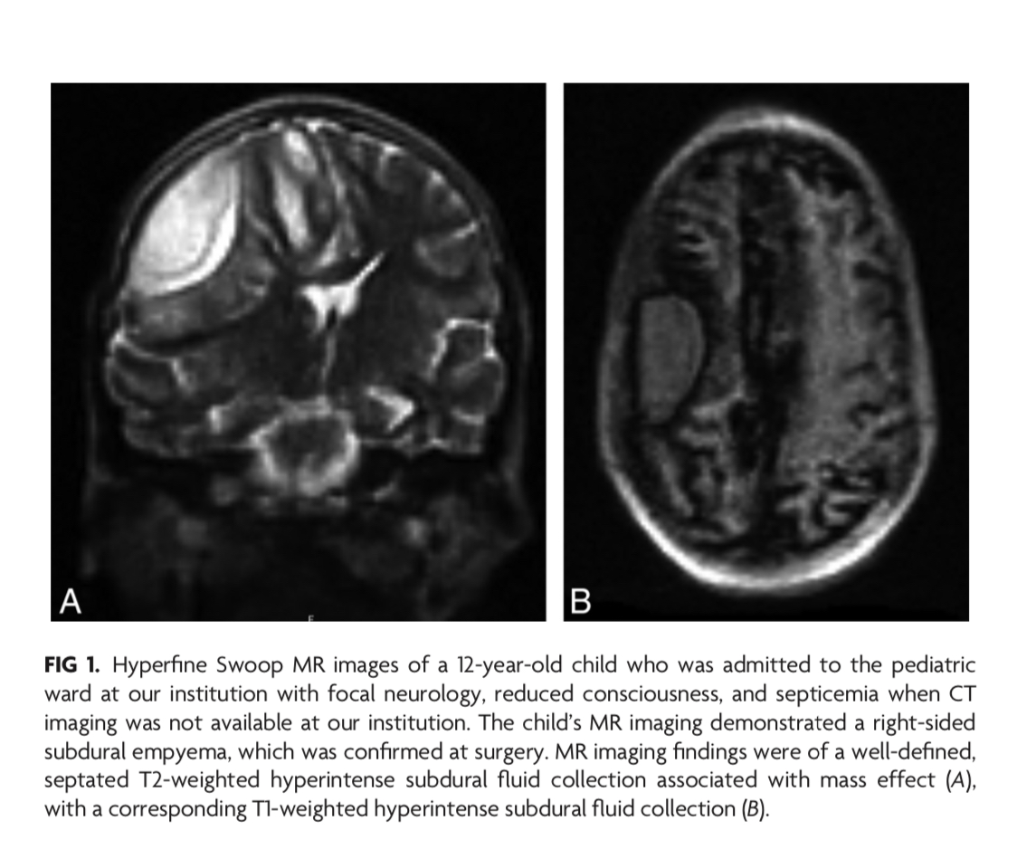 TheAJNR's tweet photo. “Implementation of a Low-Field Portable MRI Scanner in a Resource-Constrained Environment: Our Experience in Malawi” #LowFieldMRI #PracticePerspective #FellowsJournalClub   |  https://t.co/UgmISWD3HE https://t.co/tUgHkbaled