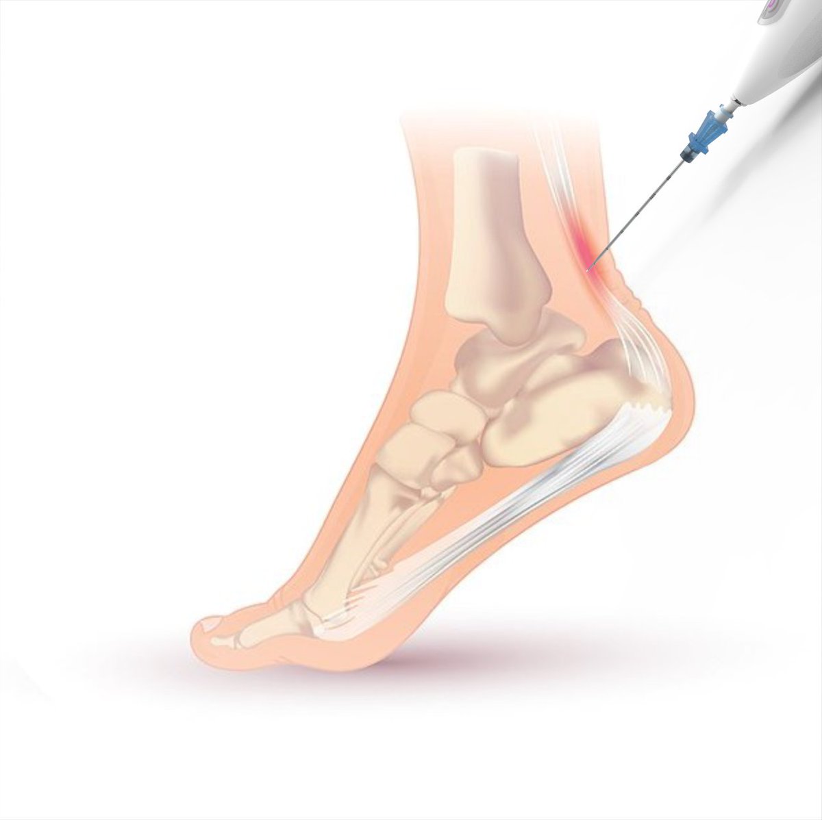 From our MBID program to FDA approval! How a master’s project has become a new tool to help people suffering with chronic tendon pain: b.gatech.edu/3wkuYbu