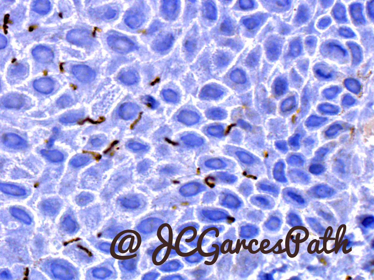 JCGarcesPath's tweet photo. Treponema #syphylis #immunhistochemistry. @gonzadetoro @MSLDermatopato @pembeoltulu @JMGardnerMD @JCandidoXavier https://t.co/c0TJyBbCQK