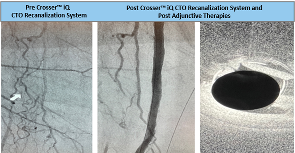 TimHugBD's tweet photo. 15cm CTO in the proximal and mid-SFA artery. Dr. Cawich crossed using #CrosseriQ catheter and observed a 1 min 54 sec activation time. #CrossThisFast
For use in peripheral artery CTOs; Not for use in carotid arteries. Safety info: https://t.co/9SArCDy8G0 https://t.co/tC9X8Ym9J3