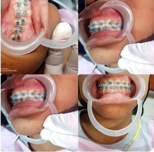 SmileRamatlotlo's tweet photo. A happy heart and a perfect smile go hand in hand, get braces now...

Call/WhatsApp us on 0693293794 or visit any of our branches at Hazyview, Tonga, Nelspruit, BushBuck Ridge, Acornhoek, Ermelo, Newcastle, Witbank, Elukwatini and Pretoria.
#CapitecMoneyIn l Friday the 13th https://t.co/0a3w0IDGuB
