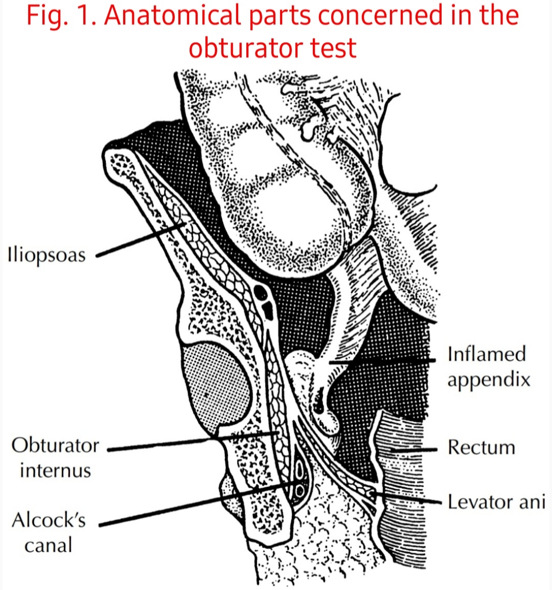 Obturator Test