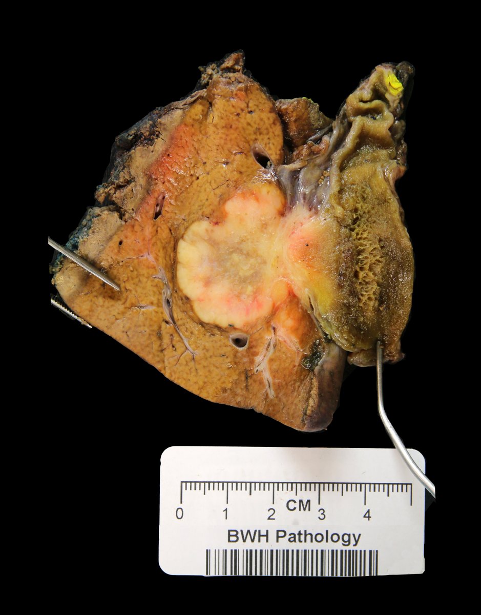 Brigham and Women's Pathology tweet media