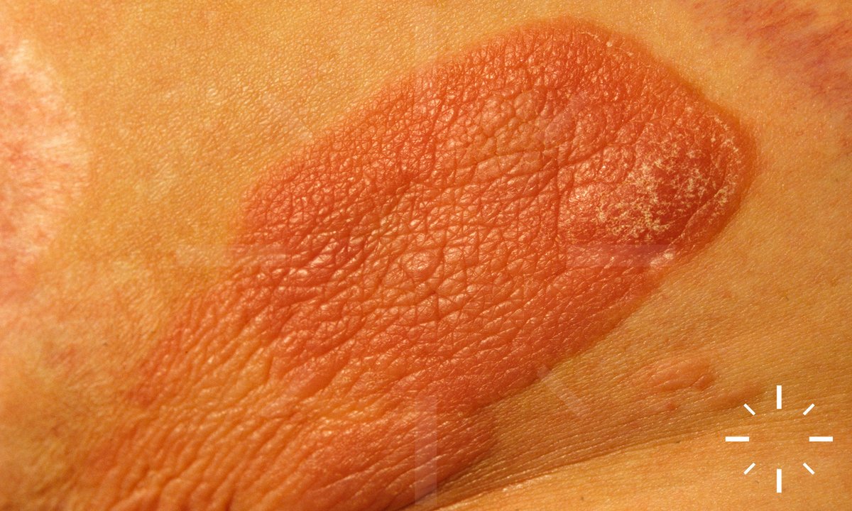 HealthKarger's tweet photo. May is #MelanomaAwarenessMonth. But don't forget about other skin cancers. "The heterogeneity and complexity of cutaneous T-cell #lymphomas can always present us with challenges in everyday treatment", says Prof. Max Schlaak in Kompass Dermatologie
#KargerHCP https://t.co/BlPshQRBWO