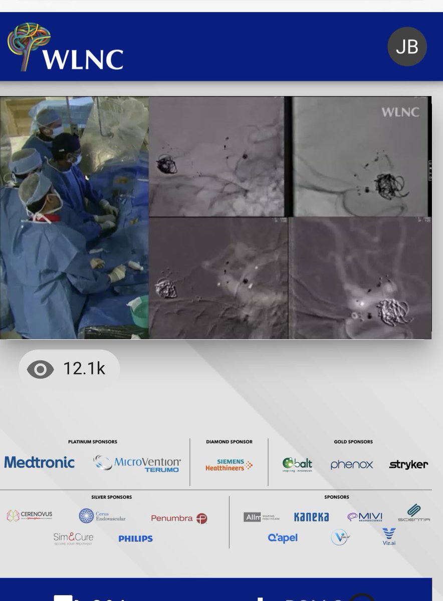 JanKarlBurkhar1's tweet photo. Watching #WLNC during lunch break in clinic @PennNSG #cerebrovascular #neurosurgery Strong LIVE work by Buffalo group @_AdnanSiddiqui @EladLevyMD @JMDaviesMDPhD 1) #Web/#FredX for Acom and PCom #aneurysms in same patient 2)venous stenting. 13k+ viewers ‼️congrats! @cvsection https://t.co/PxdfKtfG0g