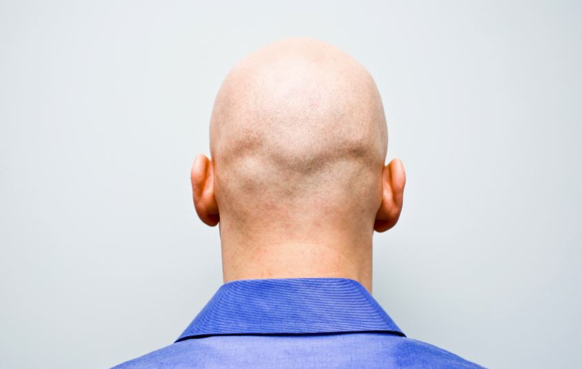 DailyMirror's tweet photo. Calling a man 'bald' is considered sexual harassment, tribunal rules
https://t.co/PrwqBK3rf4 https://t.co/xCxcVmII9A