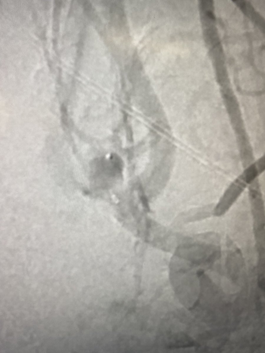 Doctor_OC_'s tweet photo. Fenestrations can be our friend when treating wide based #aneurysms. Here an acomm fenestration helped with intrasaccular treatment of a wide based acomm aneurysm @PennNSG @PennNeurology @PennRadiology @BAFOUND @YoungNIR @MV_Terumo @SiemensHealth https://t.co/0oGC7JYjLX