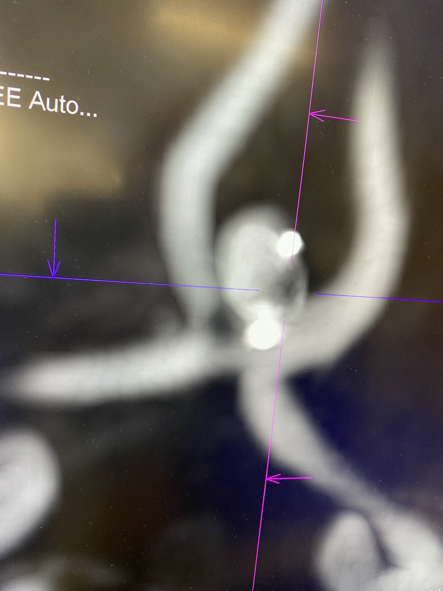 Doctor_OC_'s tweet photo. Fenestrations can be our friend when treating wide based #aneurysms. Here an acomm fenestration helped with intrasaccular treatment of a wide based acomm aneurysm @PennNSG @PennNeurology @PennRadiology @BAFOUND @YoungNIR @MV_Terumo @SiemensHealth https://t.co/0oGC7JYjLX