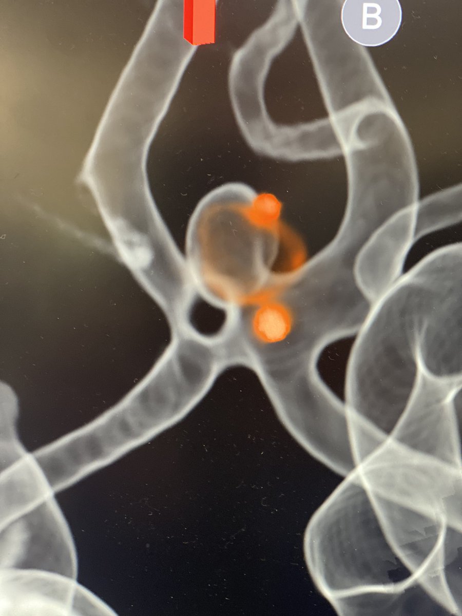 Doctor_OC_'s tweet photo. Fenestrations can be our friend when treating wide based #aneurysms. Here an acomm fenestration helped with intrasaccular treatment of a wide based acomm aneurysm @PennNSG @PennNeurology @PennRadiology @BAFOUND @YoungNIR @MV_Terumo @SiemensHealth https://t.co/0oGC7JYjLX