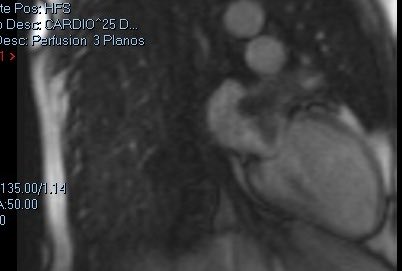 rgmarenchino's tweet photo. A 73-year-old woman  with cardiac sarcoma located in the left atrial appendage with mitral annulus involvement. 
Surgical resection, atrial and annular reconstruction with bovine pericardial patch and mitral valve replacement with cardiac auto-transplantation technique https://t.co/pZwAscktgw