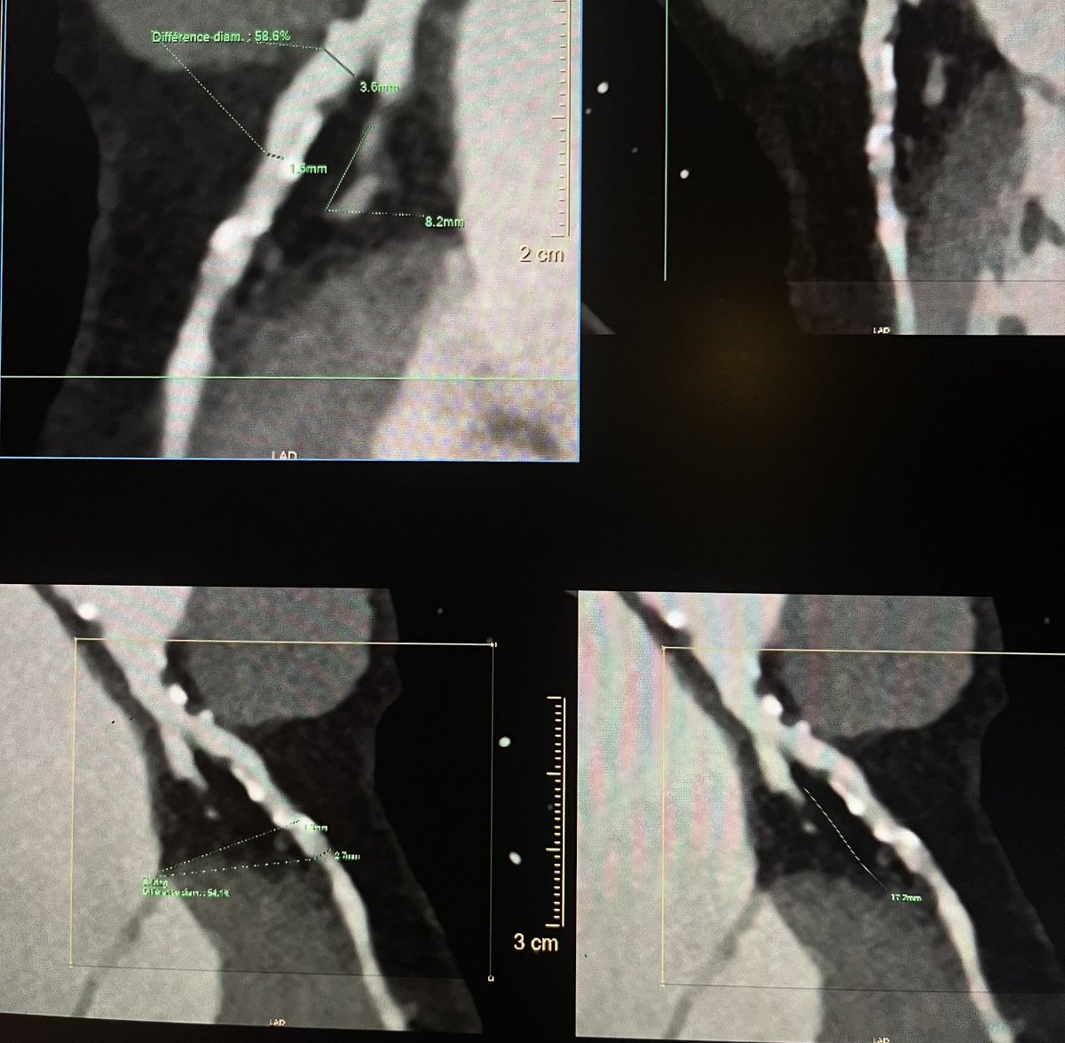 SABOURETCardio's tweet image. #WhyCCT frailty woman with chest pain during walk. Normal EKG, normal TTE, no rise in Troponin, but need for a diagnosis.