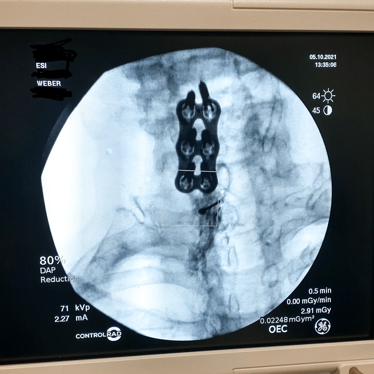 The ControlRad tablet, in real-time, optimizes image quality in the region of interest (ROI) while reducing unnecessary radiation in the periphery. ControlRad.com #reduceradiation #radiationsafety