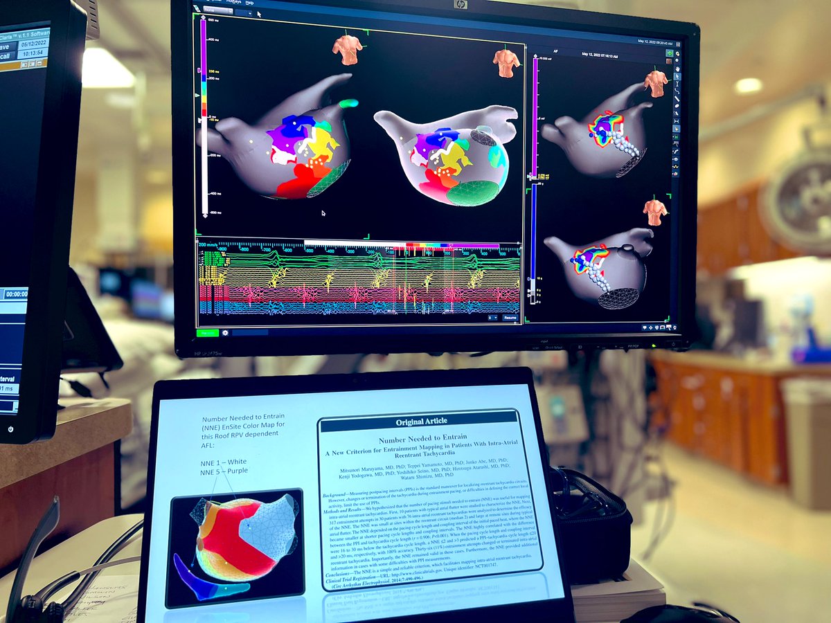 Ashit Patel (@ashit_eps) on Twitter photo Snapshot of left atrial flutter with prior PVI. CS paced map, revealed #ILAM & #DZ <a href="/EPWoodsShop/">Christopher Woods</a> predicted circuit isthmus. Closed Window Technique right, displaying voltage with usual high correlation. Entrainment confirmed <a href="/AbbottCardio/">Abbott Cardiovascular</a> #PDXMapping <a href="/forkknifecab_EP/">Brock Gambill</a> <a href="/PaigeMazur/">Paige Mazur</a> Snapshot of left atrial flutter with prior PVI. CS paced map, revealed #ILAM & #DZ <a href="/EPWoodsShop/">Christopher Woods</a> predicted circuit isthmus. Closed Window Technique right, displaying voltage with usual high correlation. Entrainment confirmed <a href="/AbbottCardio/">Abbott Cardiovascular</a> #PDXMapping <a href="/forkknifecab_EP/">Brock Gambill</a> <a href="/PaigeMazur/">Paige Mazur</a>