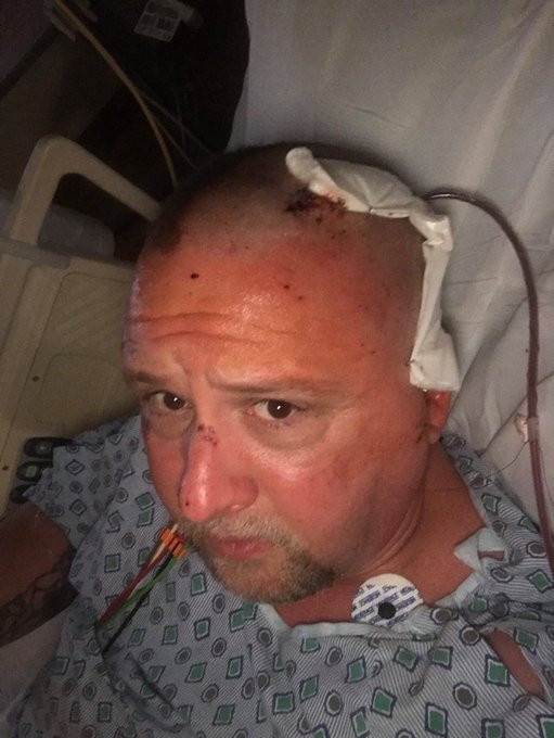 My 2018 Motorcycle wreck results: #TramaticBrainInjury . #SubduralHematoma right side brain #EpiduralHematoma<a href="/tag/tramaticbraininjury"class="tags">#TramaticBrainInjury</a><a href="/tag/subduralhematoma"class="tags"><span>#subduralhematoma</span></a><a href="/tag/epiduralhematoma"class="tags"><span>#epiduralhematoma</span></a><a href="/tag/cranioto"class="tags"><span>#cranioto</span></a>