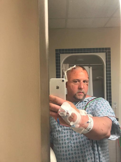 My 2018 Motorcycle wreck results: #TramaticBrainInjury . #SubduralHematoma right side brain #EpiduralHematoma<a href="/tag/tramaticbraininjury"class="tags">#TramaticBrainInjury</a><a href="/tag/subduralhematoma"class="tags"><span>#subduralhematoma</span></a><a href="/tag/epiduralhematoma"class="tags"><span>#epiduralhematoma</span></a><a href="/tag/cranioto"class="tags"><span>#cranioto</span></a>