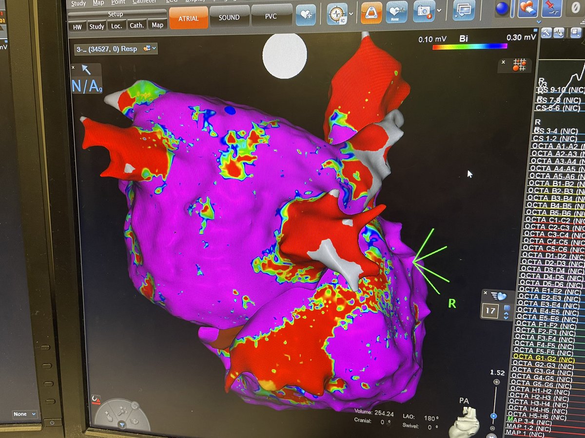 Anil Rajendra (@anilrajendra1) on Twitter photo Over 400cc of atrial volume… 😬🫣#EPeeps Over 400cc of atrial volume… 😬🫣#EPeeps