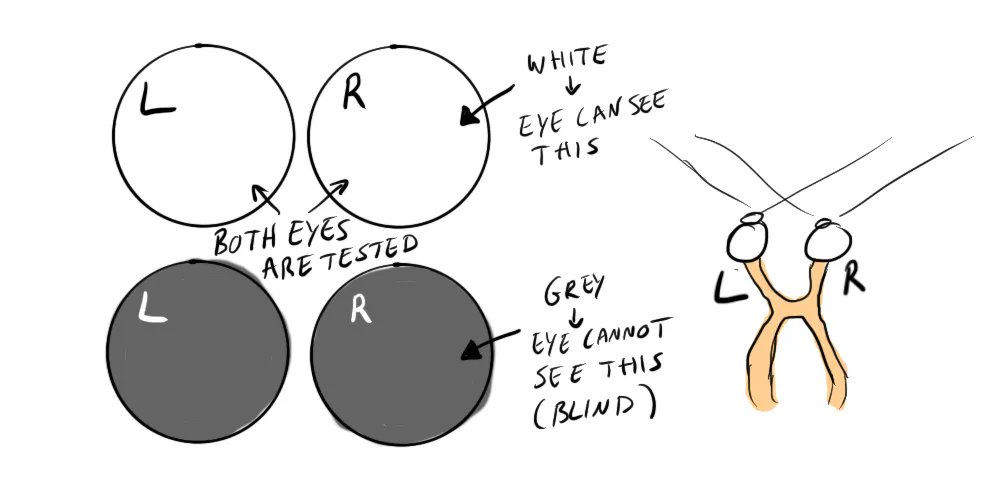 glassofbrain's tweet photo. When looking at your eyes, doctors might talk about a "visual field", what? Read more here: https://t.co/KmGwU4XDqV

#neuroscience #eye #anatomy #medical #brain #science https://t.co/gu7DJp2d8X