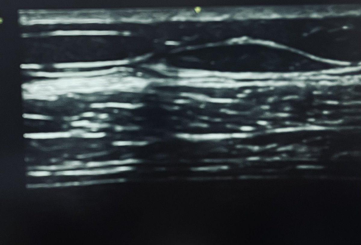 FOAMecmo's tweet photo. Diaphragm #POCUS to monitor resp muscle function/assist weaning
1️⃣ diaphragmatic thickening/thickening fraction: mid axillary 8-10 ICS. Any effort? Overassistance??
2️⃣ excursion: subcostal liver/spleen windows INSP moves caudally = toward probe: no/paradoxical movement?
#LIVES40 https://t.co/S28VrXSPH5