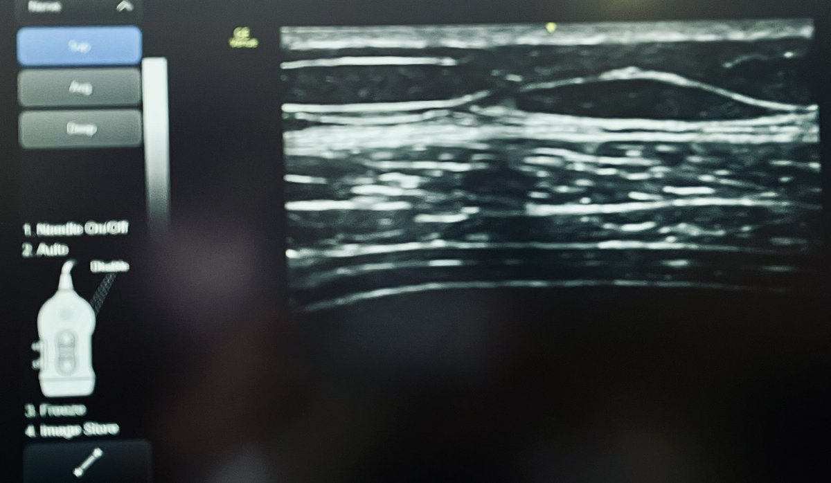 FOAMecmo's tweet photo. Diaphragm #POCUS to monitor resp muscle function/assist weaning
1️⃣ diaphragmatic thickening/thickening fraction: mid axillary 8-10 ICS. Any effort? Overassistance??
2️⃣ excursion: subcostal liver/spleen windows INSP moves caudally = toward probe: no/paradoxical movement?
#LIVES40 https://t.co/S28VrXSPH5