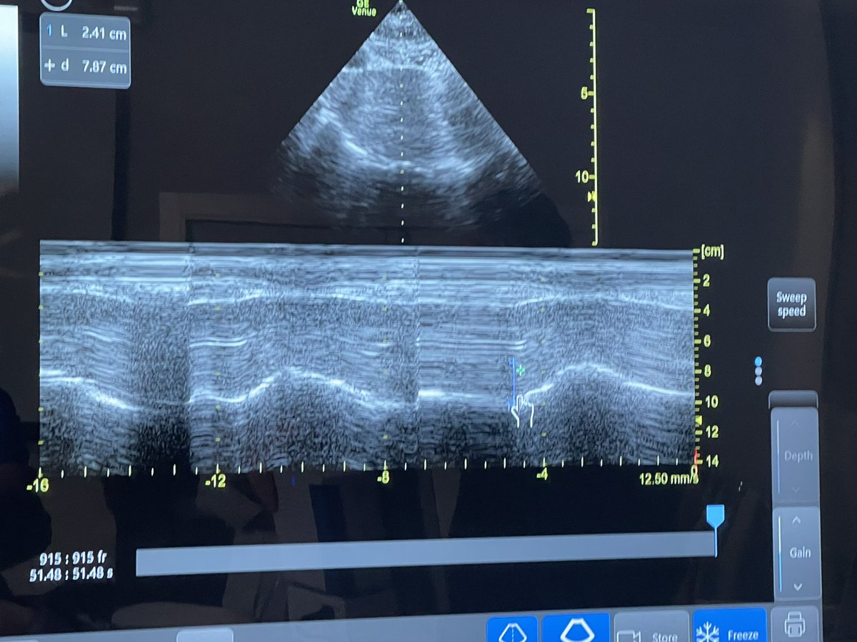 Diaphragm #POCUS to monitor resp muscle function/assist weaning
1️⃣ diaphragmatic thickening/thickening fraction: mid axillary 8-10 ICS. Any effort? Overassistance??
2️⃣ excursion: subcostal liver/spleen windows INSP moves caudally = toward probe: no/paradoxical movement?
#LIVES40