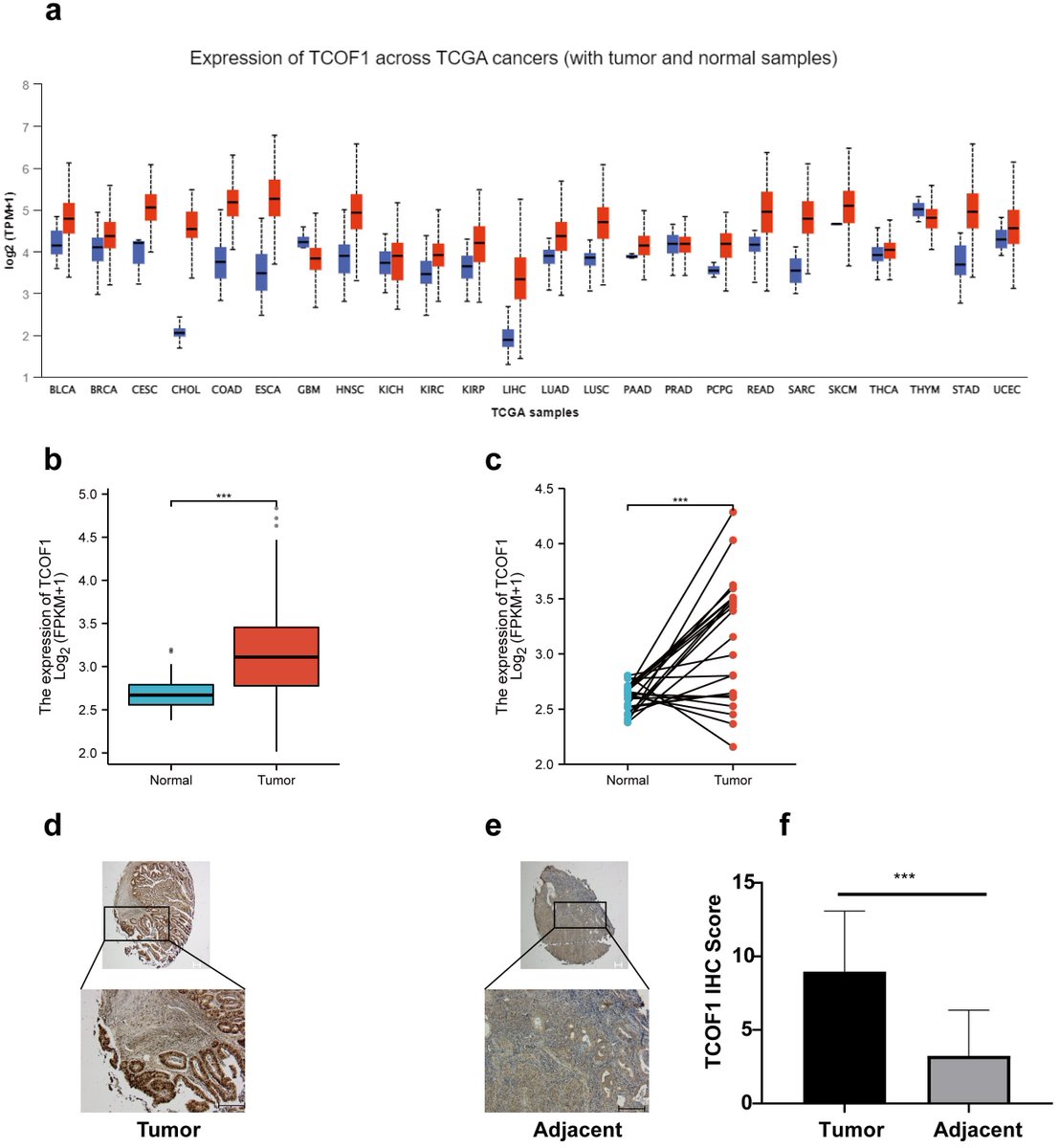 CEOGjournal's tweet photo. #TCOF1 is Identified to be an Unfavorable #Biomarker and is Associated with #Molecular #Classification in #Endometrial #Cancer
🥳the first paper of Special Issue: Current Research on Endometrial and #Ovarian #Cancers
🔗https://t.co/dSqg9el51s https://t.co/LgfgFBzAQm