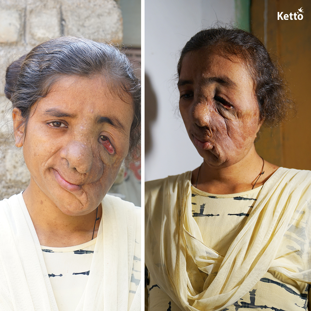 "My 23-yo daughter's face is covered in lesions that have impacted her vision and physical health. Despite being qualified, employers reject her due to her appearance, which really disheartens her."

Please help: bit.ly/Save-Rajani