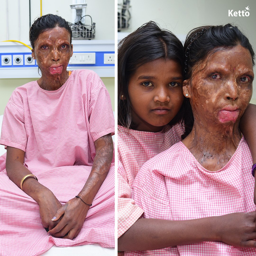 "My 29-yo wife's face, chest and neck bear the scars of a fire accident she suffered two years ago. She dislikes attending family gatherings and looking in the mirror due to her appearance. Your support can help give her her old life back!"

Please help: bit.ly/Save-Sunita