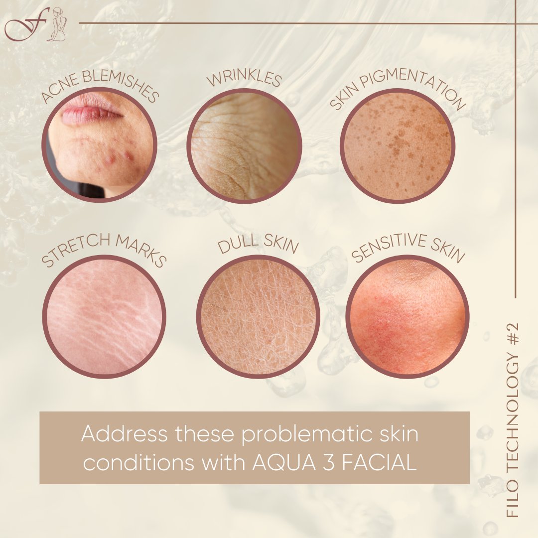 thefiloclinic's tweet image. AQUA-3 has been proven to be effective against ❌Acne Blemishes, ❌Wrinkles, ❌Skin Pigmentation, ❌Dull &amp;amp; Sensitive Skin and even ❌Stretch Marks. 
#prp #cellularmatrix #aestheticclinic